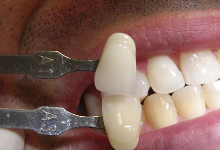 bleaching